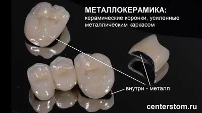 Керамические коронки на зубы: много плюсов и один минус | Центр Современной  Стоматологии, Москва