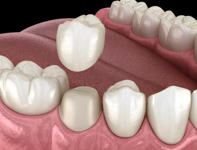 Металлокерамическая коронка -