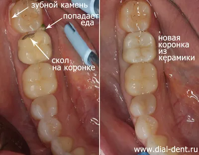 Неметаллическая керамическая коронка