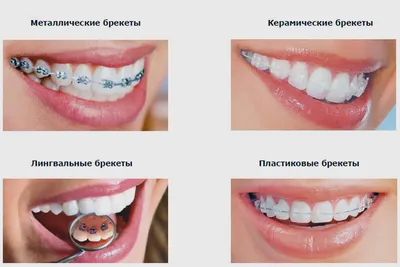 Керамические брекеты отзывы Харьков