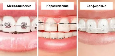 Керамические брекеты: фото, цена, особенности