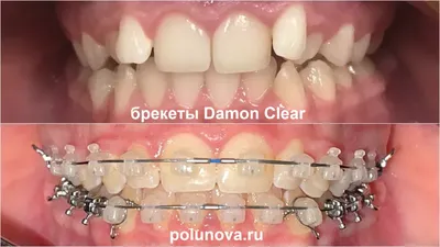 Керамическая лигатурная брекет система, особенности установки | Клиника  Ортодонтика, Москва