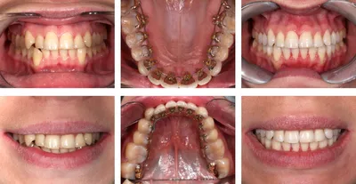 Керамические брекеты − прекрассная эстетика