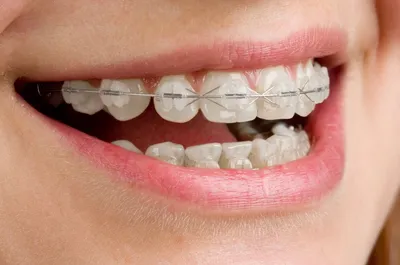 О стоматологии и не только...: Меняют ли керамические брекеты цвет?