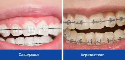 Керамические брекеты, цена установки (лигатурные и безлигатурные системы) |  НоваДент