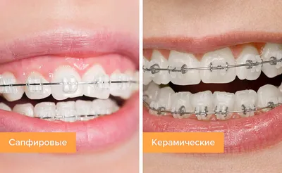 Керамические и сапфировые брекеты — отличия и какие лучше? | Журнал  Startsmile о стоматологии | Дзен