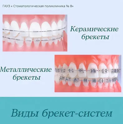 Сапфировые брекеты, цена в Москве от 19900 руб. Сапфировая брекет система.