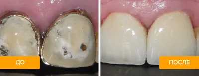 Керамический зубной протез и керамические коронки – преображение улыбки