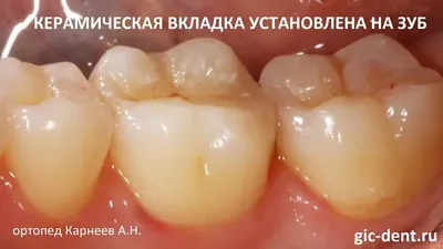 Установка виниров и коронок женщинам после 50 лет. Клиника Smile STD в  Измайлово