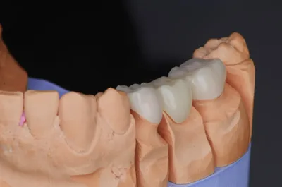 Керамическая вкладка на зуб в Тюмени, цена - ЮниДент