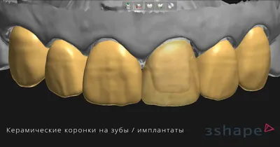 Виниры для зубов можно ставить только при правильном прикусе - клиника  Ортодонтика, Москва