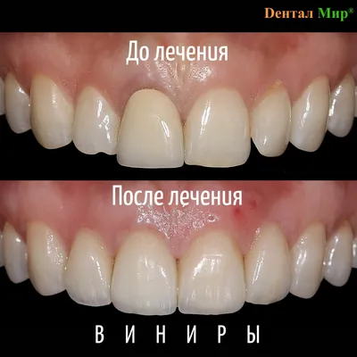 Эстетическая реставрация керамическими коронками E-max | Estetica Dent