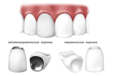 Керамические зубы — Виды и преимущества зубных коронок