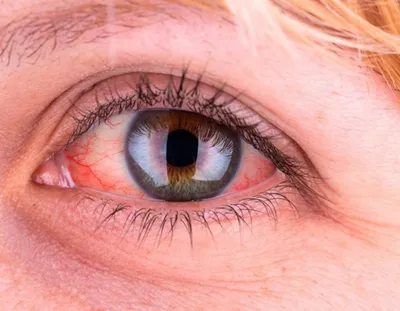 Вирусный кератит глаза - симптомы, лечение