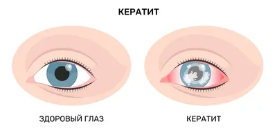 Клиническая больница \"РЖД-Медицина\" г.Пенза - Кератит — воспаление роговицы  глаза, проявляющееся преимущественно её помутнением, изъязвлением, болью и  покраснением глаза. Может иметь травматическое или инфекционное (грипп,  туберкулёз и др ...