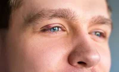 Почему воспаляется роговица глаз: чем опасен кератит — Здоров-Инфо
