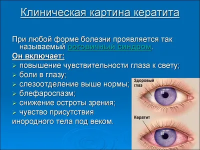 Кератит: причины, виды, симптомы, диагностика и лечение кератита в Москве -  сеть клиник «Ниармедик»