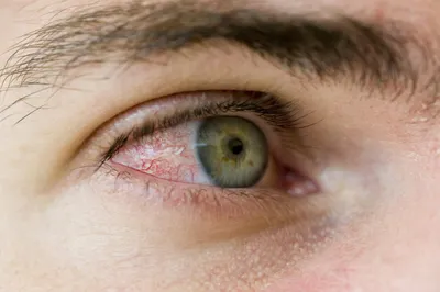 Воспалительные поражения глаз: классификация