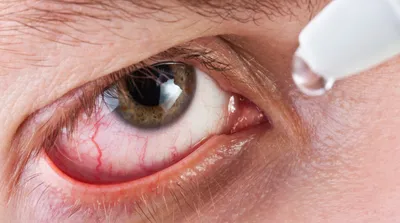 Кератит: симптомы, лечение, причины и виды кератита глаза у взрослых