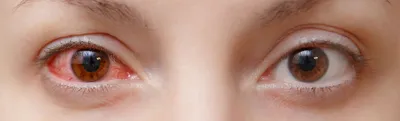 На фотографии глаза запечатлён грибковый кератит. Это очень болезненное и  неприятное состояние глаза, обусловленное воспалением роговицы… | Instagram