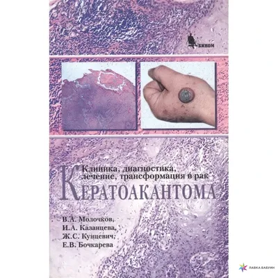 Как обнаружить предраковые заболевания кожи? | ГБУЗ \"Нехаевская ЦРБ\"