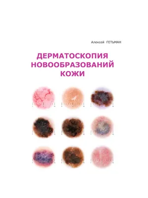 Дерматопатологические признаки плоскоклеточного рака кожи и актинического  кератоза: консенсусные критерии и руководство по написанию заключений  (JAAD, февраль 2023)