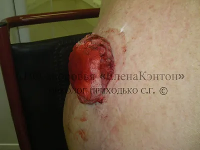 Пройти диагностику и лечение опухолевых заболеваний кожи в Москве, цена