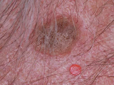 Пилярный кератоз ( фолликулярный, «гусиная кожа», keratosis pilaris) ⠀  Фолликулярный кератоз у детей является распространенным безвредным… |  Instagram