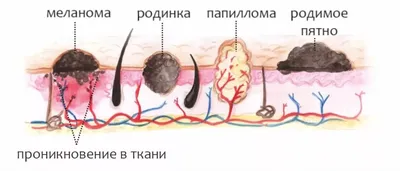 Себорейная кератопапиллома кожи и головы (ФОТО): способы лечения и удаления  кератомы
