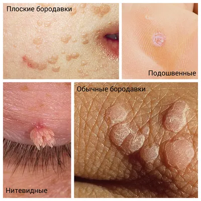 Папиллома кожи (Skin papilloma) — это доброкачественная опухоль из  эпителиальной ткани, выстилающей поверхность кожи, вызванная вирусом… |  Instagram