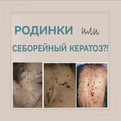 SKINCOUTURE on Instagram: \"#БиблиотекаДермаквест Себорейный Кератоз -  распространенное состояние, чаще встречается у взрослых и пожилых людей.  Многие часто путают его с пигментацией. ⠀ 3 ОТЛИЧИЯ Себорейного кератоза от  Пигментации ⠀ ✓ВИЗУАЛЬНО ...