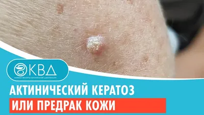 Себорейный кератоз или родинки? | Uniserv Medical Center