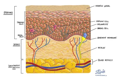 Себорейный кератоз | MyPathologyReport.ca