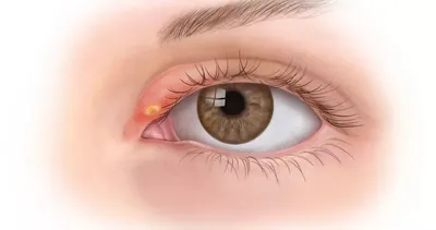 Ячмень на глазу (гордеолум): симптомы, причины и лечение у взрослых в ФНКЦ  ФМБА