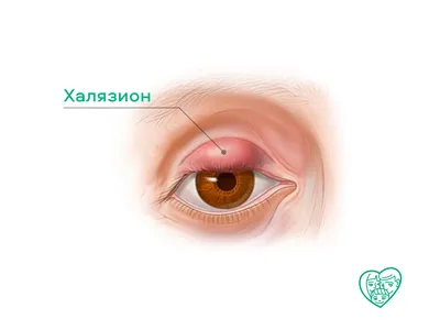 Можно ли носить контактные линзы при халязионе? «Ochkov.net»