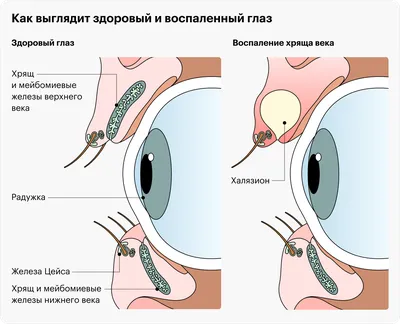 Халязион – причины, симптомы и лечение халязиона, профилактика | Ниармедик