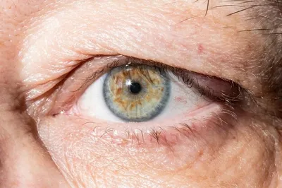 Халязия - что это за болезнь глаза? Опухлость века в уголку глаза -  Советчица