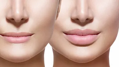 Удаление биополимерного геля из губ: фото до и после — через 1 месяц |  Пластический хирург Орландо Салас