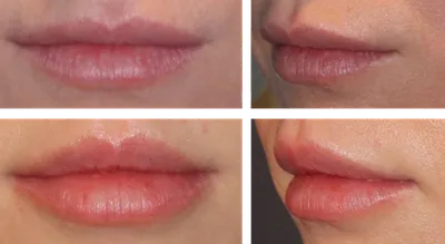 Коррекция формы губ ᐉ цена увеличения губ • фото • Хейлопластика, отзывы  пациентов из Киева и Харькова