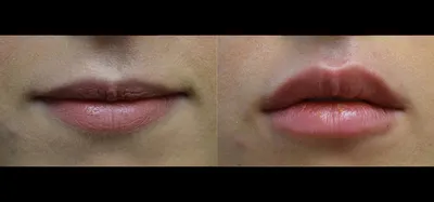 Пластика губ (хейлопластика) → Фото результатов до и после пластической  операции