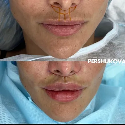 Фото до и после - Пластика губ (хейлопластика)
