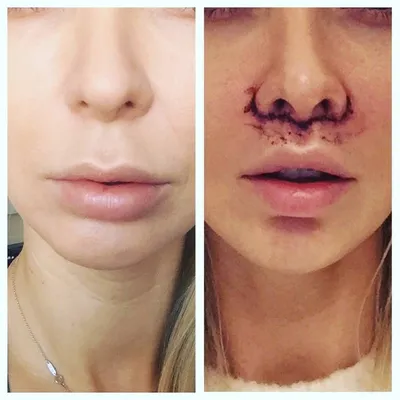 Увеличение губ - хейлопластика | Цены на пластику губ | фото до и после