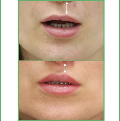 Пластика губ (фото до и после) – Исамутдинова Г. М.