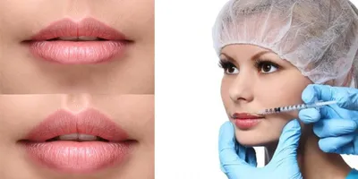 Увеличение губ гиалуроновой кислотой: до и после — через 2 недели |  Пластический хирург Орландо Салас