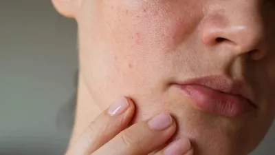 Демодекоз на лице и других участках тела - Клиника в Уручье