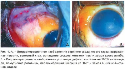 External photograph of the right eye taken by the patient before the... |  Download Scientific Diagram