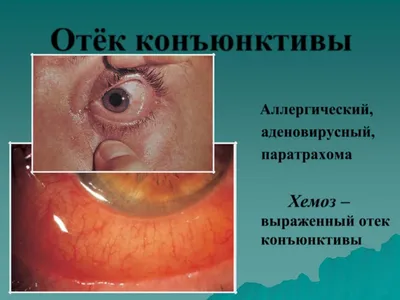 Хемоз конъюнктивы глаза: чем лечить и как не допустить?  https://apteka.ru/blog/articles/lekarstva_i_dobavki/khemoz-konyunktivi-glaza-chem-lechit-i-kak-ne-dopustit/  .. | ВКонтакте