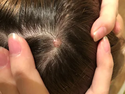 В Ровенской области девушка потеряла половину волос и часть кожи после  окрашивания волос у парикмахера – фото 18+
