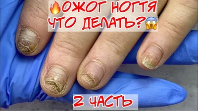 Химический и термический ожог ногтевой пластины | ВКонтакте