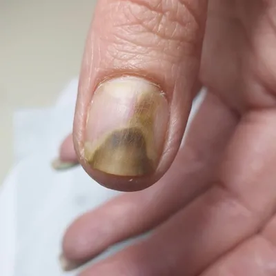 Burn of the nail plate 🔥 / How to remove a thickened nail? - YouTube